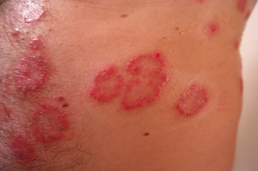 Posterydowe zapalenie skóry - co to takiego jest?